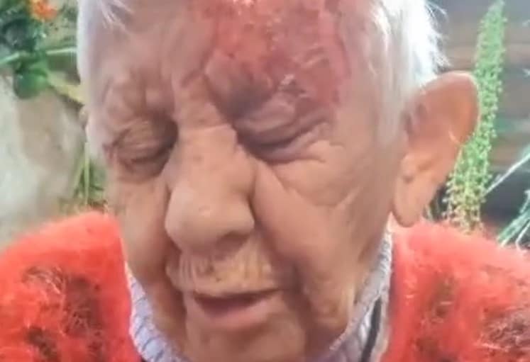 Impactante denuncia: Adulta mayor quemada con ácido en La Florida