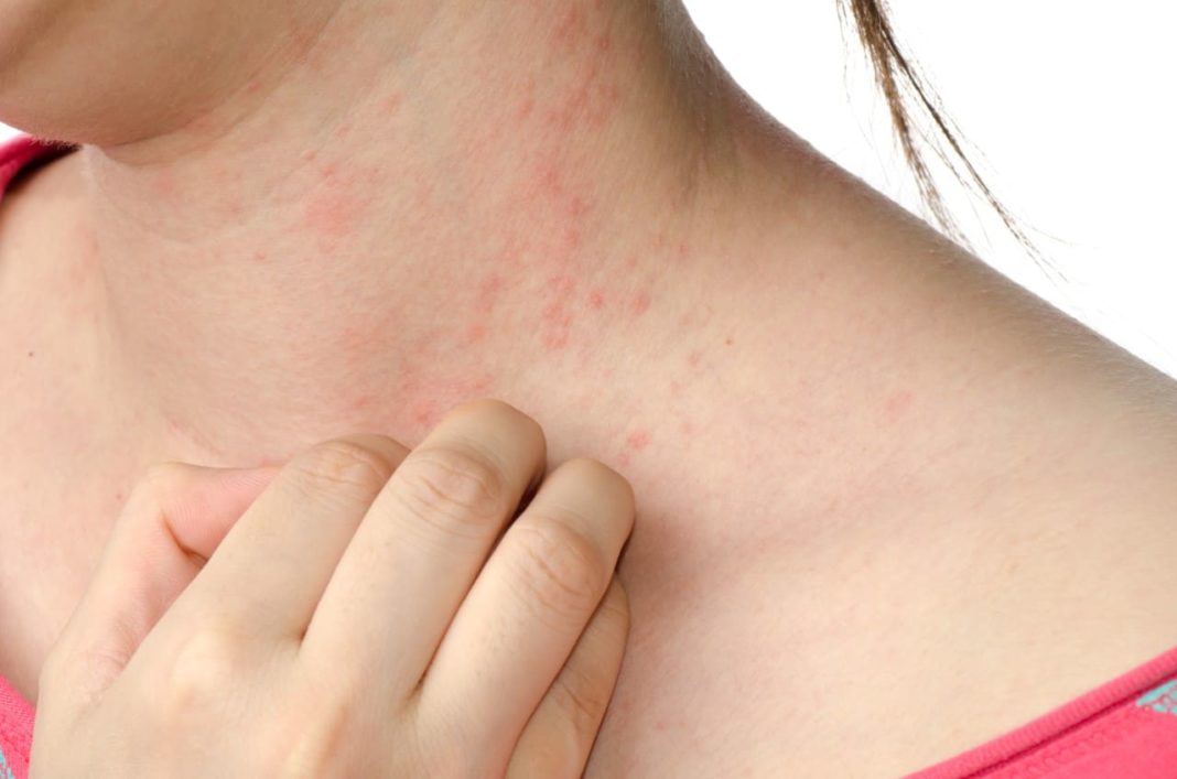 Dermatitis atópica: 5 consejos para cuidar las pieles secas