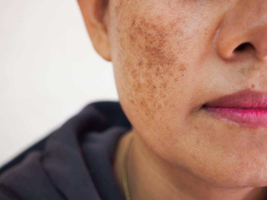 Melasma: Descubre los mejores tratamientos para eliminar las manchas en el rostro