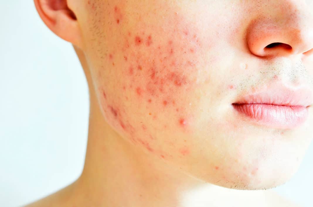 ¡Descubre las rutinas simples para el cuidado facial de los adolescentes con acné!