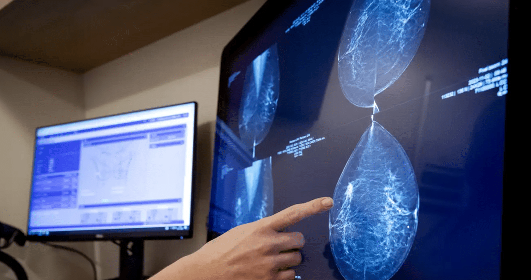 Increíble avance médico: un dispositivo en el sostén que detecta el cáncer de mama