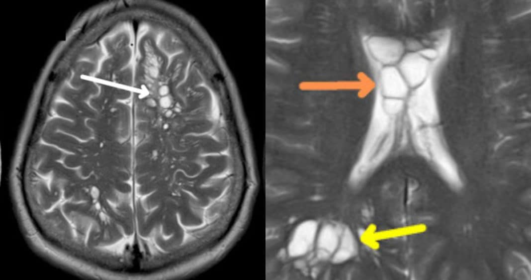 Increíble descubrimiento médico: hombre con migrañas tenía larvas en el cerebro