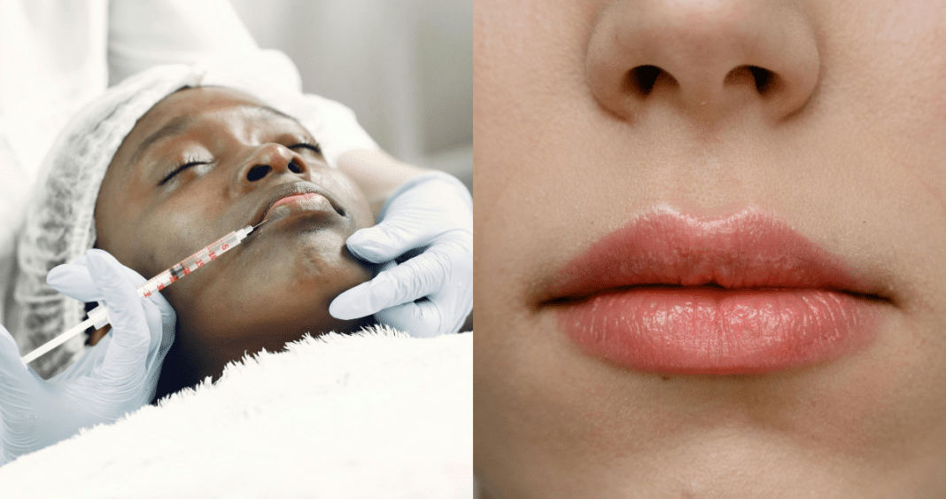 ¡Descubre la Verdad Detrás del Relleno de Labios: Experta Revela los Pros y Contras del Procedimiento Estético!