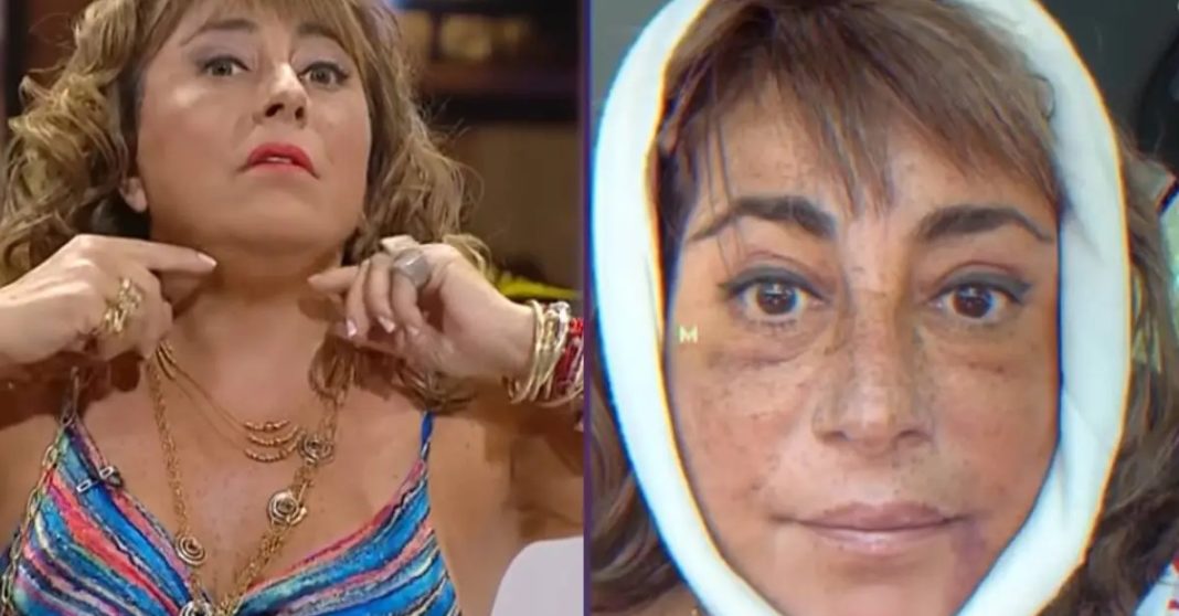 Helhue Sukni Rejuvenece con Cirugía Facial: Una Transformación Sorprendente