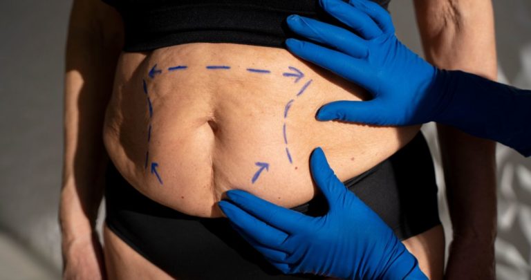 Cirugía Bariátrica con Bono PAD: Acceso Asequible y Beneficios Transformadores