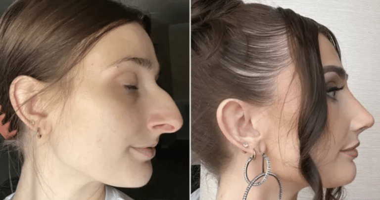 De 'Bruja' a Belleza: Cómo una Rinoplastía Transformó la Vida de una Mujer