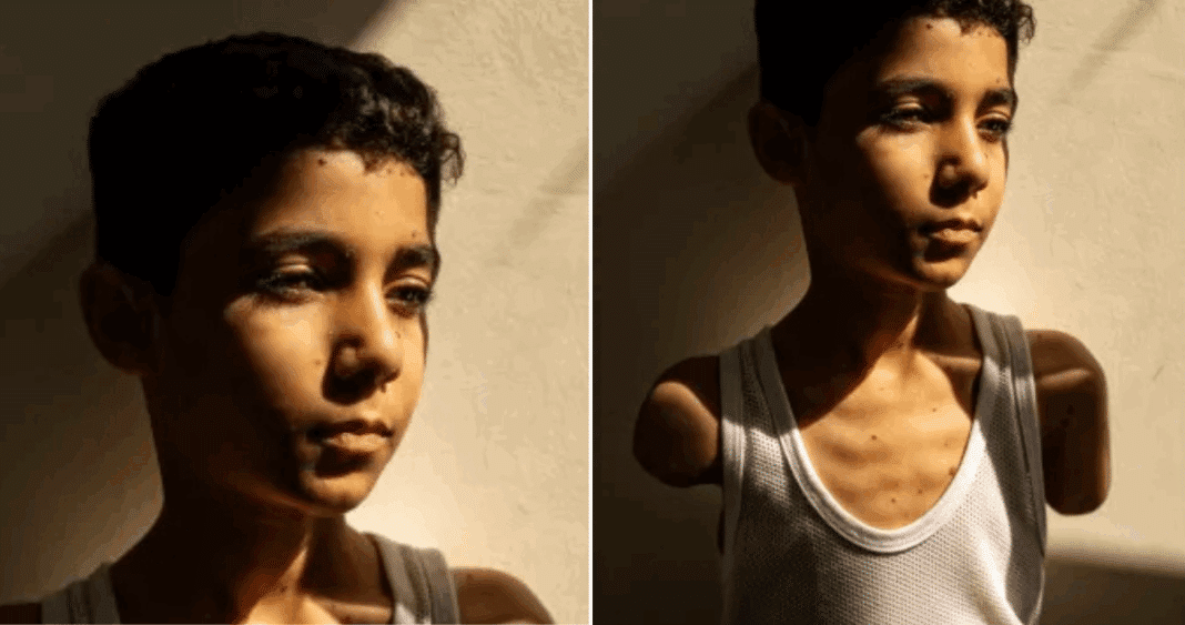 La Resiliencia de Mahmoud: Cómo un Niño Palestino Mutilado Inspiró al Mundo
