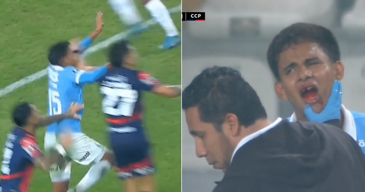 ¡Brutal Codazo Arranca Diente de Jugador Peruano en Duelo de Copa Libertadores!