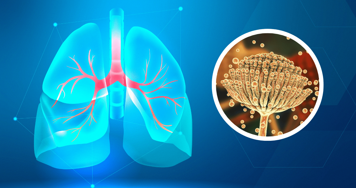 La Aspergilosis Pulmonar: Enfrentando el Desafío de una Infección Fúngica Oculta
