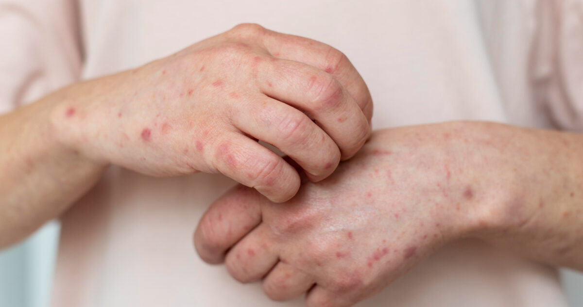 ¿Tienes entre 44 y 54 años? Podrías necesitar la vacuna contra el sarampión