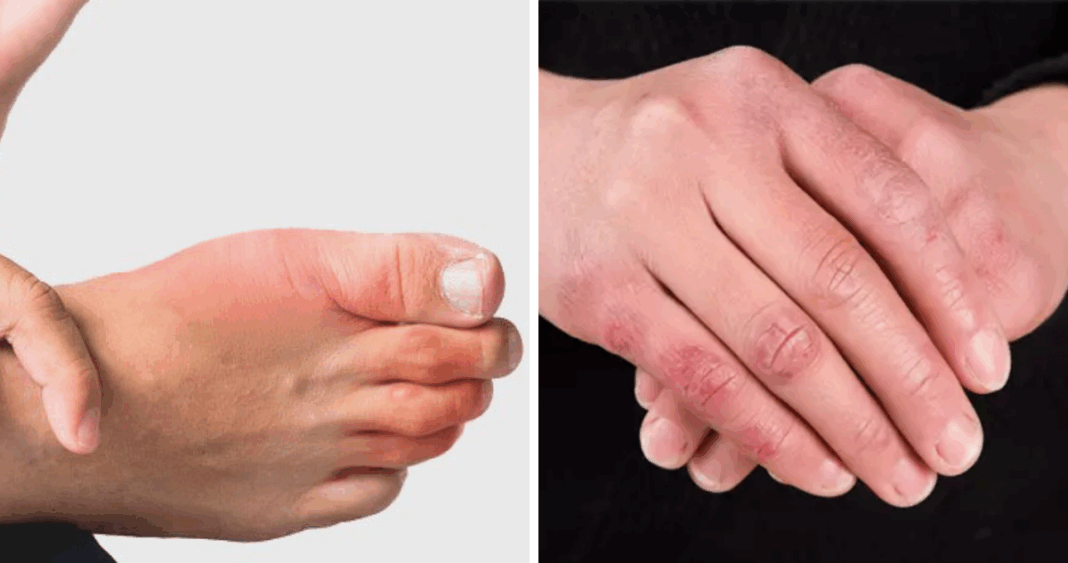 Cómo Combatir los Molestos Sabañones: Claves para Prevenir y Tratar esta Afección Invernal