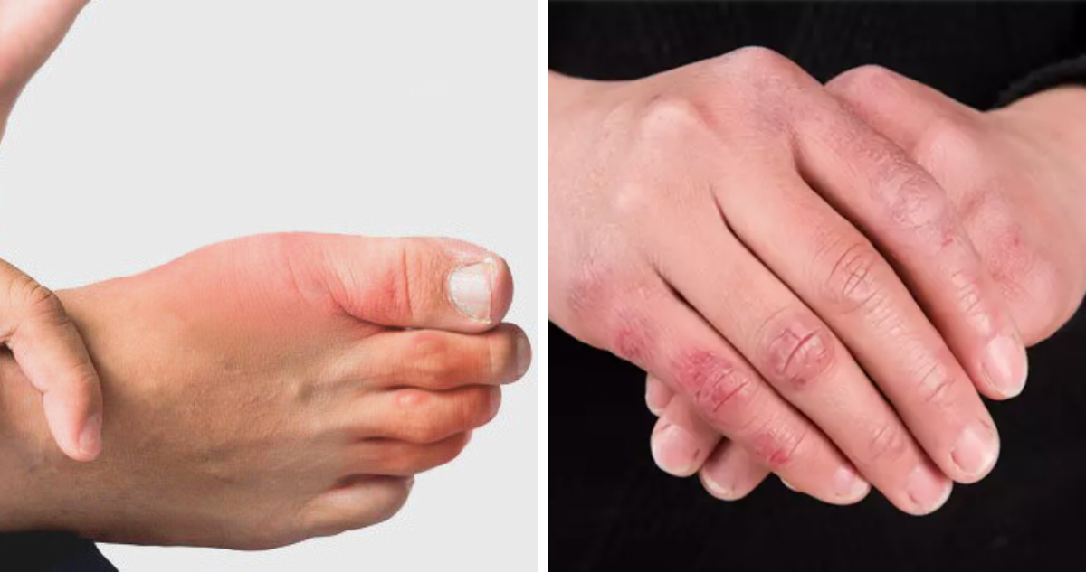 Cómo Combatir los Molestos Sabañones: Claves para Prevenir y Tratar esta Afección Invernal