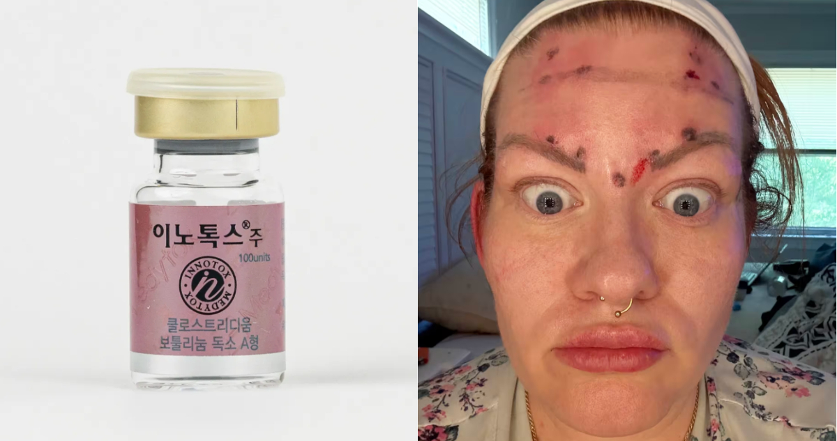 Alerta: Peligros del Bótox Coreano Barato que Muchos se Inyectan en Casa