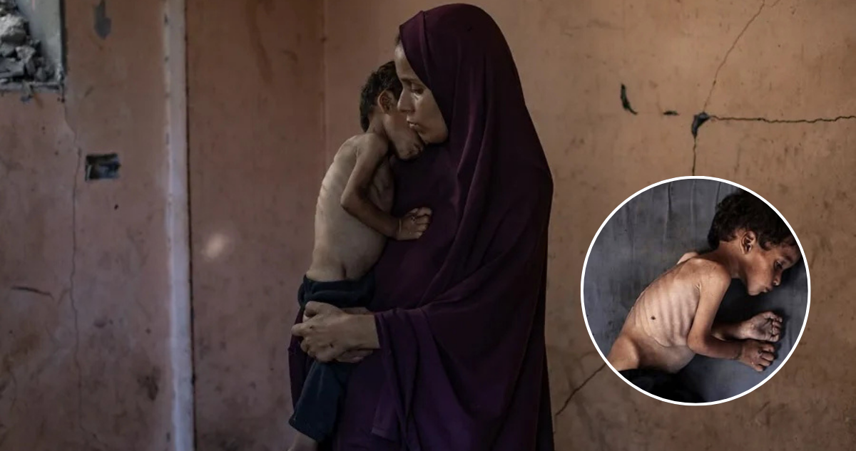 Alerta en Gaza: Niño muere de hambre mientras 70.000 más sufren desnutrición crítica