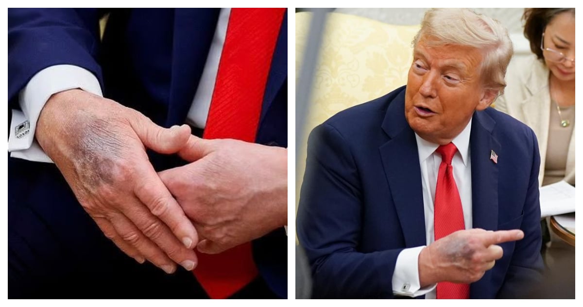El Misterioso Moretón de Trump: Revelando la Verdad Detrás de su Salud