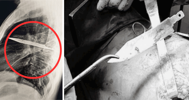 Hombre descubre cuchillo enterrado en su pecho 8 años después