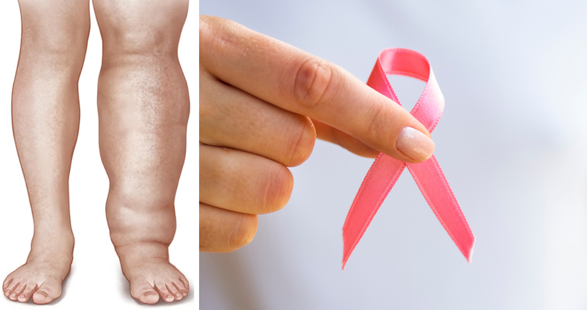 Cómo Vencer el Linfedema: La Batalla Silenciosa Tras el Cáncer de Mama