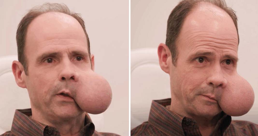 Hombre Enfrenta Lucha Contra Tumor Facial de 2 Kilos: Una Batalla por la Supervivencia