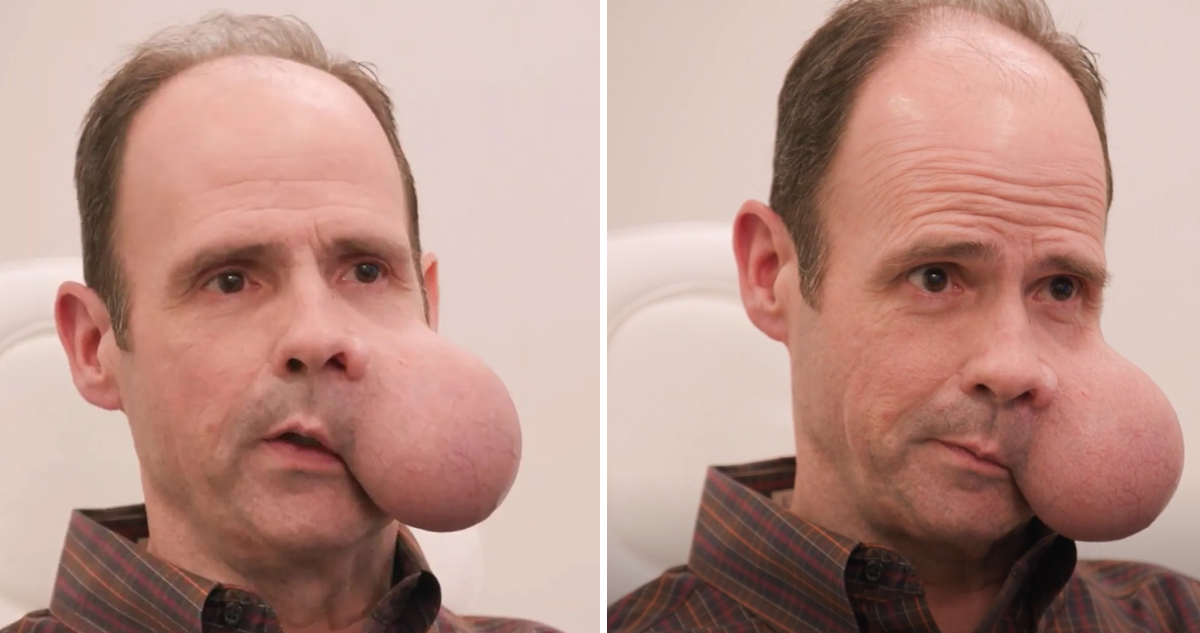 ._temp_Hombre Enfrenta Lucha Contra Tumor Facial de 2 Kilos Una Batalla por la Supervivencia Hombre Enfrenta Lucha Contra Tumor Facial de 2 Kilos: Una Batalla por la Supervivencia