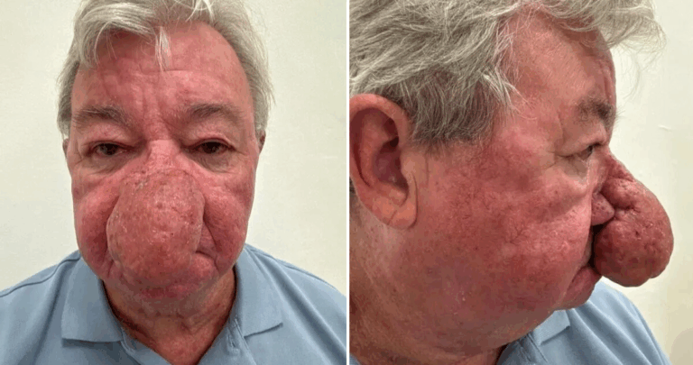 La Increíble Transformación de Gerard: Cómo Superó una Rara Enfermedad Que Deformó Su Nariz