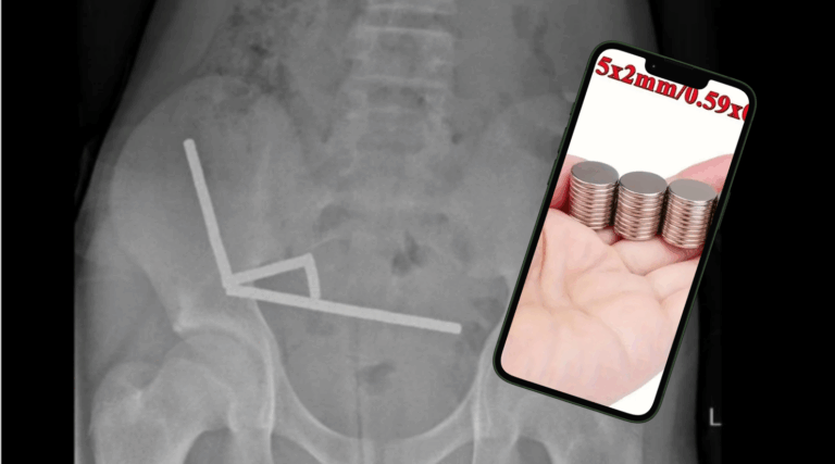 Niño ingiere 100 imanes potentes comprados en Temu y sufre grave daño intestinal