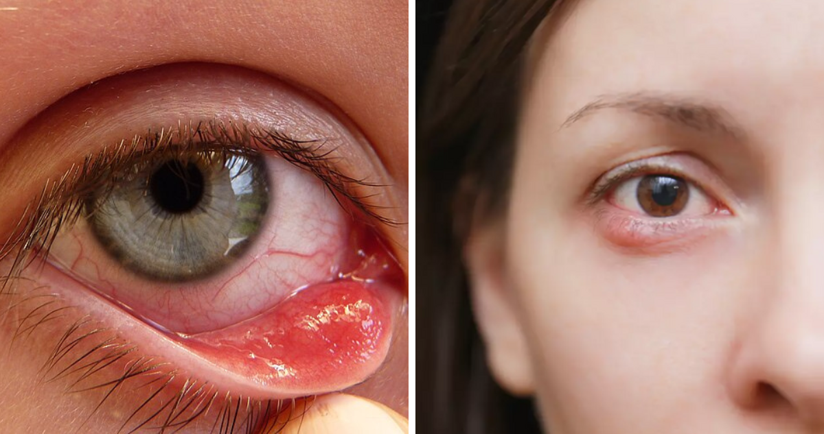 Orzuelos: Cómo Prevenirlos y Tratarlos de Manera Efectiva