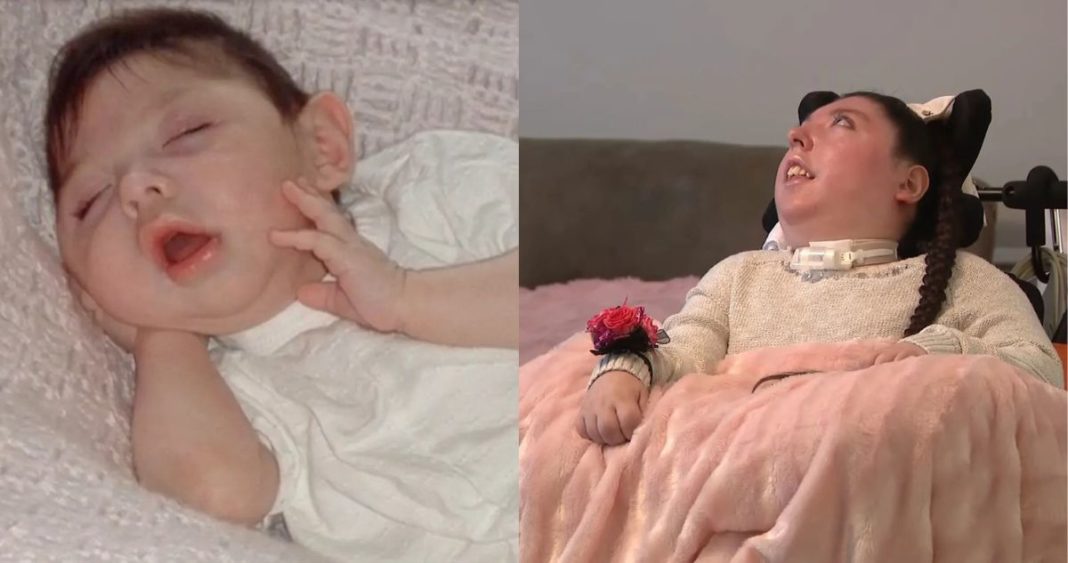 La Increíble Historia de Alex: Nacida sin Cerebro, Cumple 20 Años Desafiando los Pronósticos Médicos