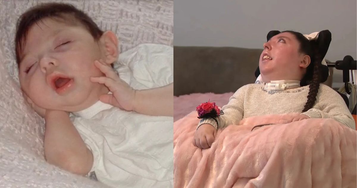 La Increíble Historia de Alex: Nacida sin Cerebro, Cumple 20 Años Desafiando los Pronósticos Médicos